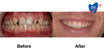 Veneers in Croatia Before & After