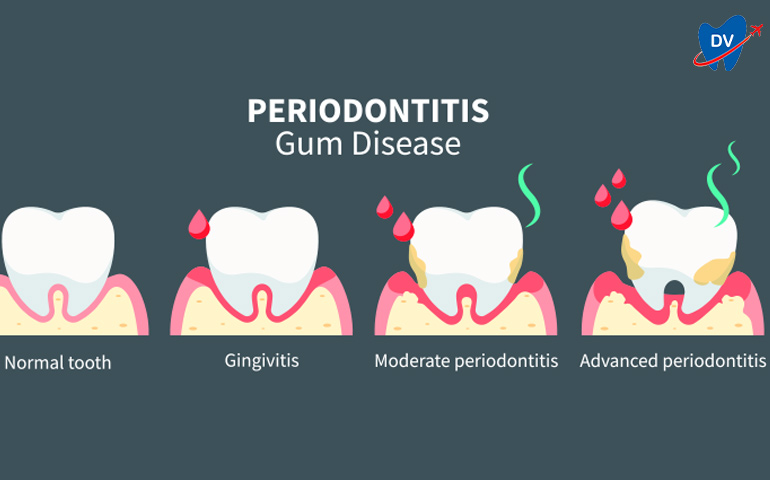 Stages of Gum Disease