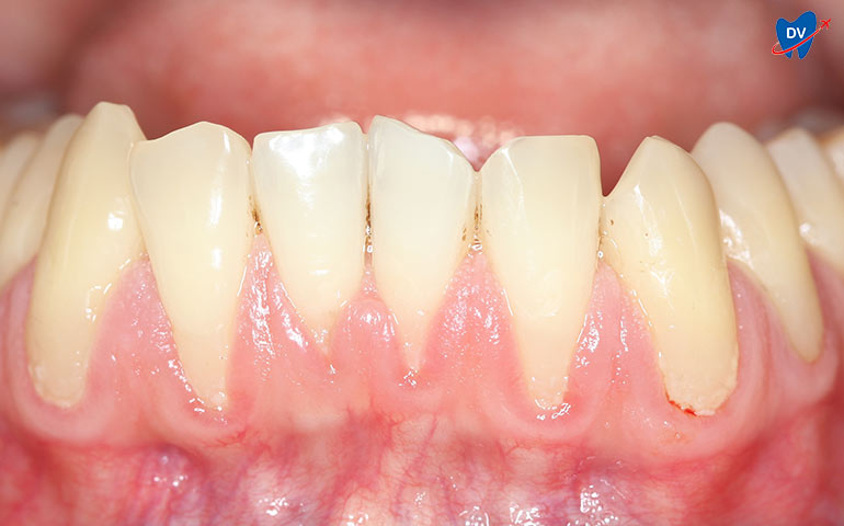 Gingival recession