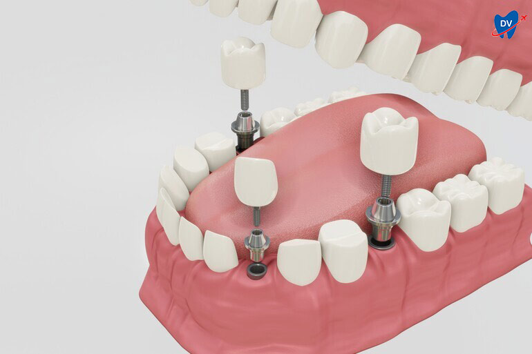 Dental Implants