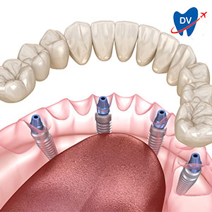 All on 4 dental implants