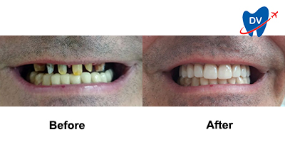 Before & After Zirconia Crowns in Sofia, Bulgaria