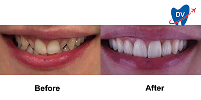 Before & After Porcelain Veneers in Sofia, Bulgaria