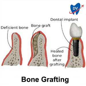 Bone Graft