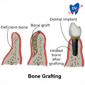 Bone Graft