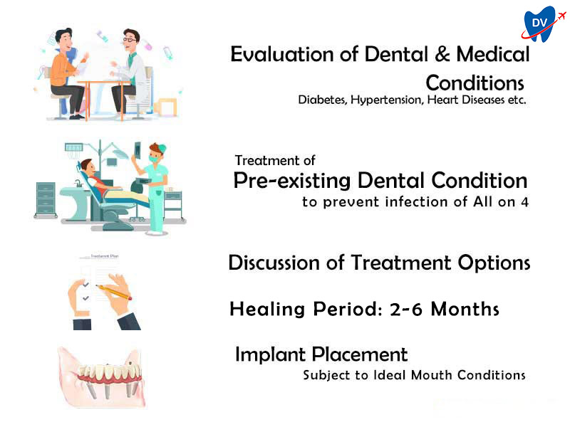 Procedure of All-on-4 Implant Placement