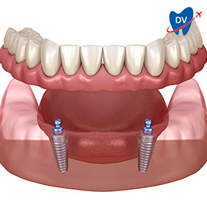 Implant retained denture in Bangalore