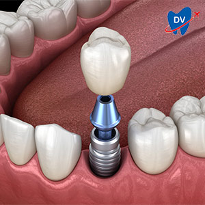 Single Tooth Implant