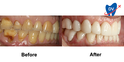 Before & After: Full Mouth Rehab in Puerto Vallarta