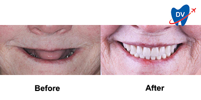 Implant Supported Dentures in Mexico - Before & After