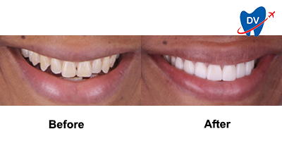 Before & After: Smile Makeover in Playa del Carmen