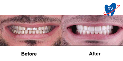 Before & After: Veneers in San Jose