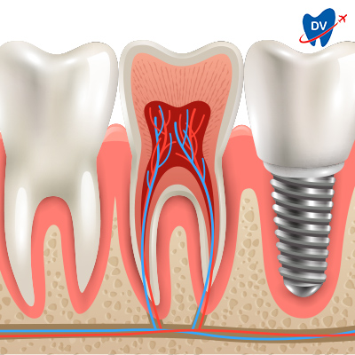 Dental Implant