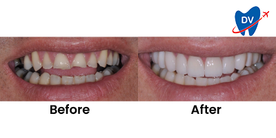 Before & After: Smile Design in Medellin