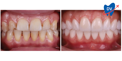 Before & After: Emax Veneers in Istanbul