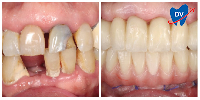 Before & After: Full Mouth Rehab in Cali