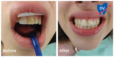 Porcelain veneers in Greece - Before & after