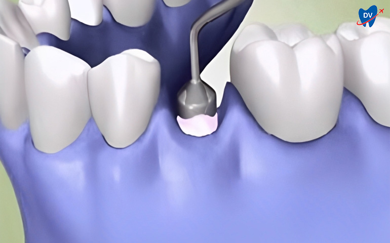 Bone Grafting