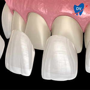 Porcelain Veneers in Tijuana