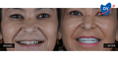 Smile Makeover in Guatemala