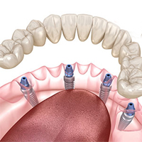 All-on-4 Dental Implant