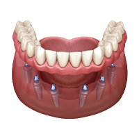 All-on-6 Dental Implants Romania