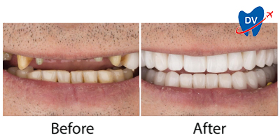 Smile Transformation After All on 4 Implants in Izmir