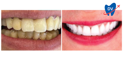 Before & After: Zirconia Veneers in Tekirdag