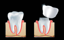 Dental Crowns In HCMC, Vietnam