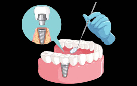 Turkey Teeth Implants