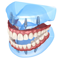 Dental Implants