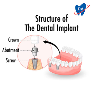 Parts of a Dental Implant