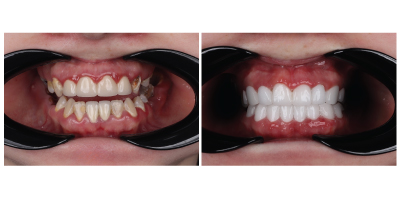 zirconium crowns and 8 implants