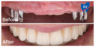 Before & After Dental Implants in Turkey