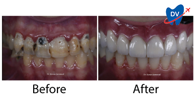 Before & After Dental Implants in Sri Lanka