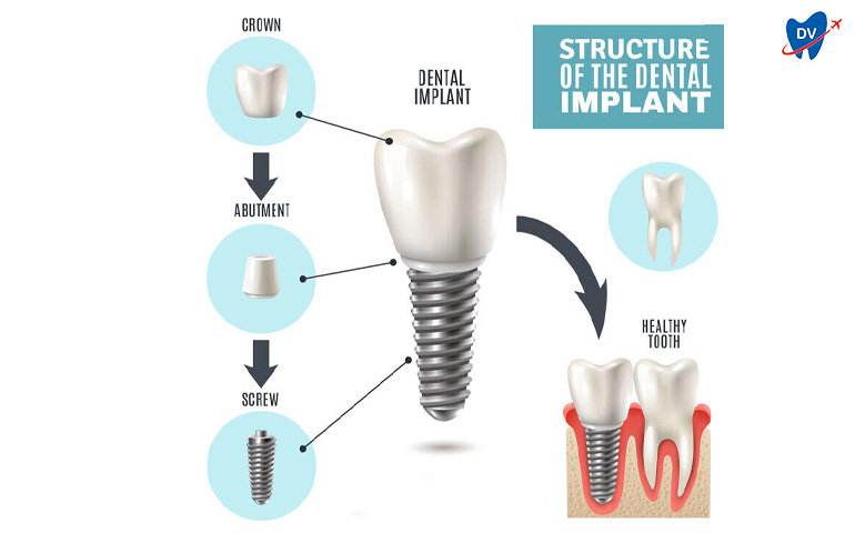 Parts of Dental Implant