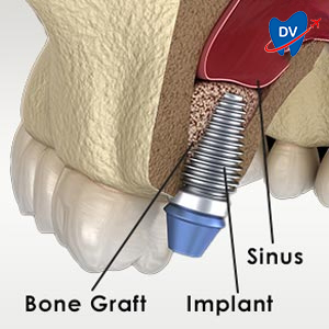 Sinus Lift