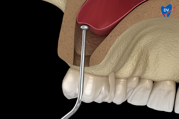 Sinus lift