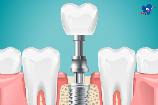 Abutment Placement