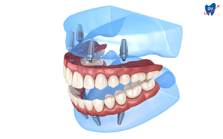 Full Mouth Implants in Turkey