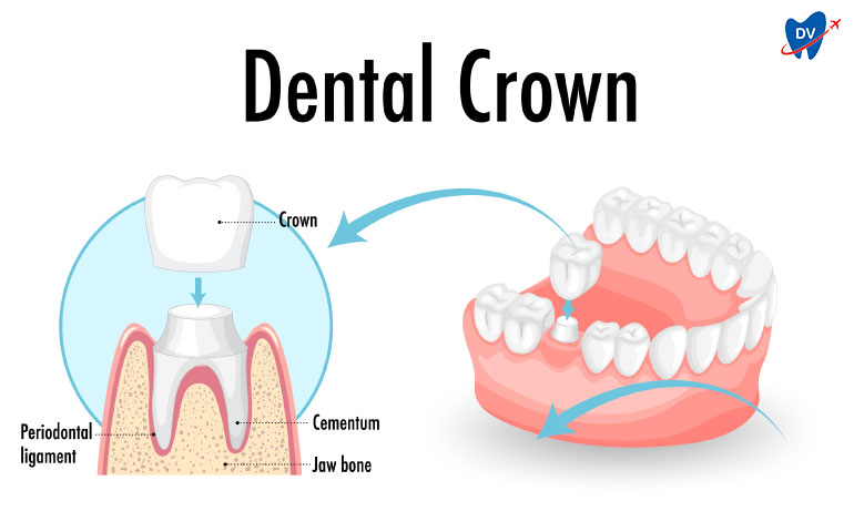 Dental Crown