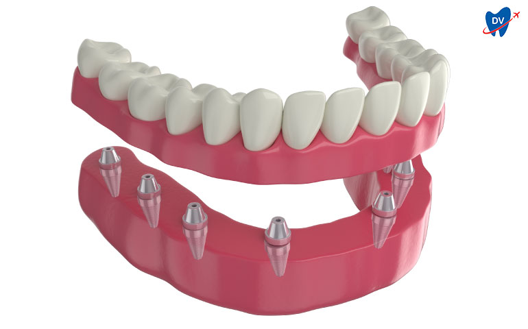 Hybrid Denture