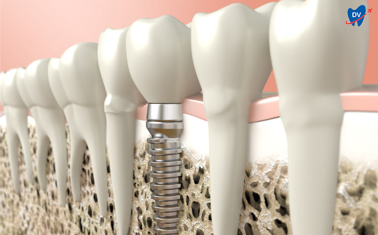 Osseointegration