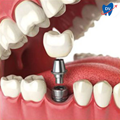 Single Tooth Implant