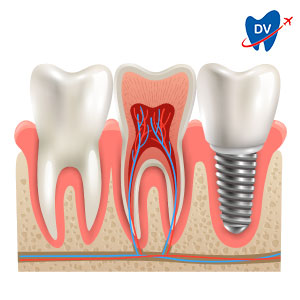 Single Unit Dental Implant in Romania