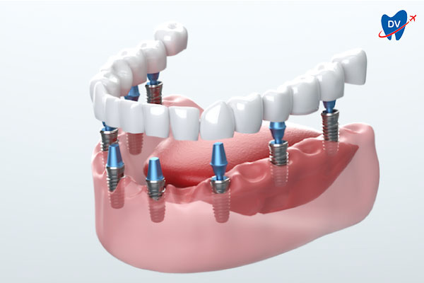 Tooth Placement