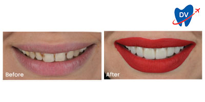 Veneers in Turkey | Before and After