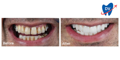 Veneers in Turkey Before and After