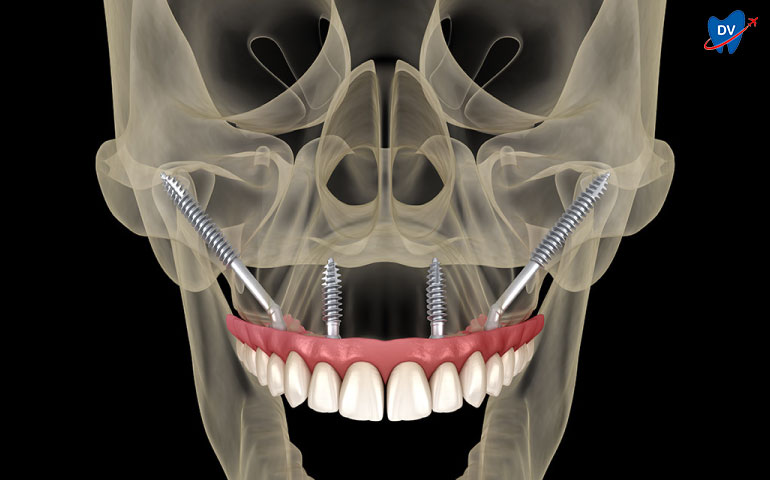 Zygomatic Implants in Costa Rica