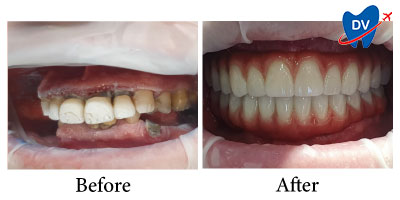 Bucharest Dental Implants Before & After